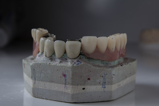 Dental Implants